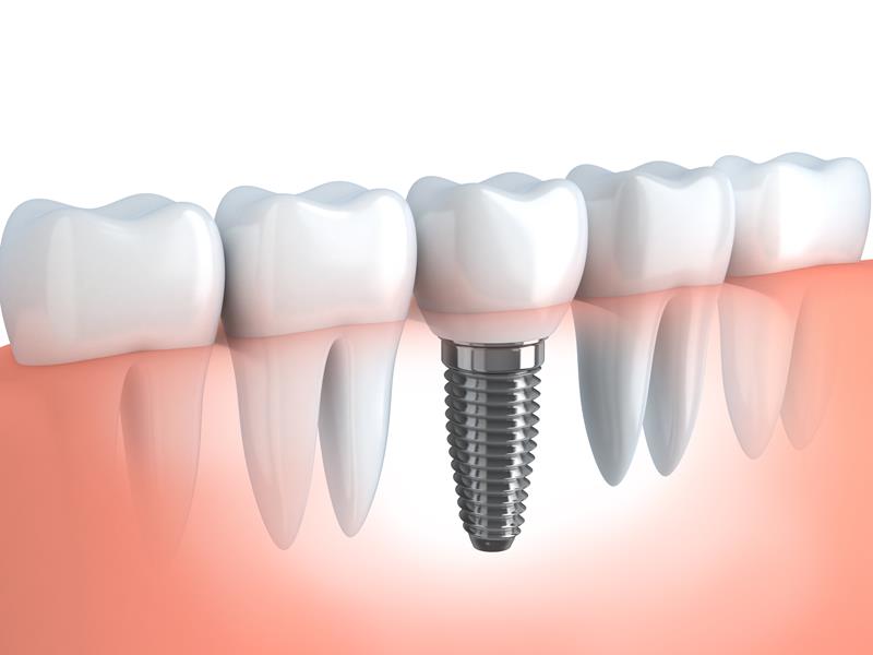 Dental Implants St Charles, MO 