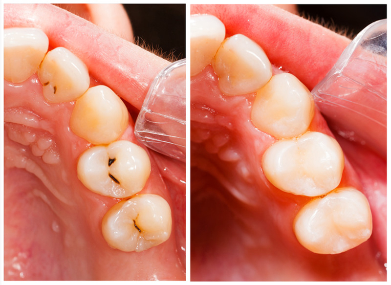 Fillings St Charles, MO 