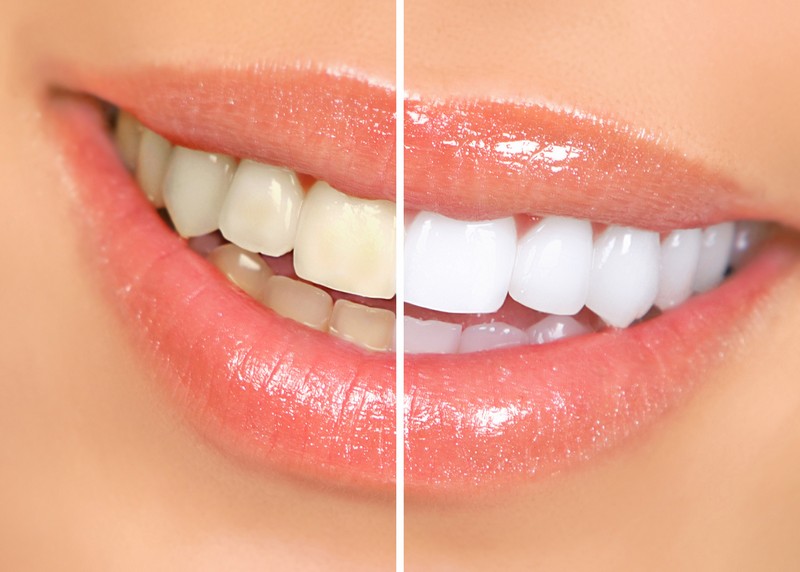 Teeth Whitening St Charles, MO 