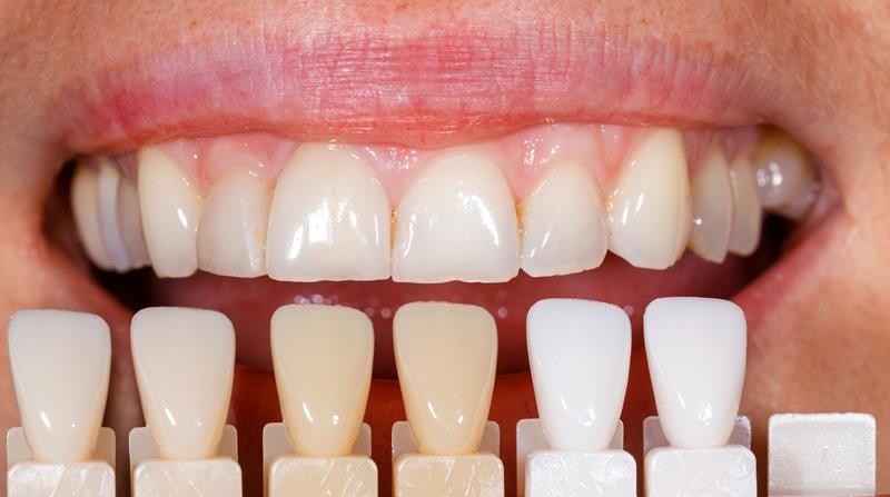 Veneers St Charles, MO 